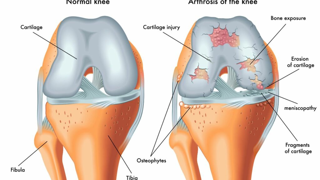 Genoux normaux et avec arthrose