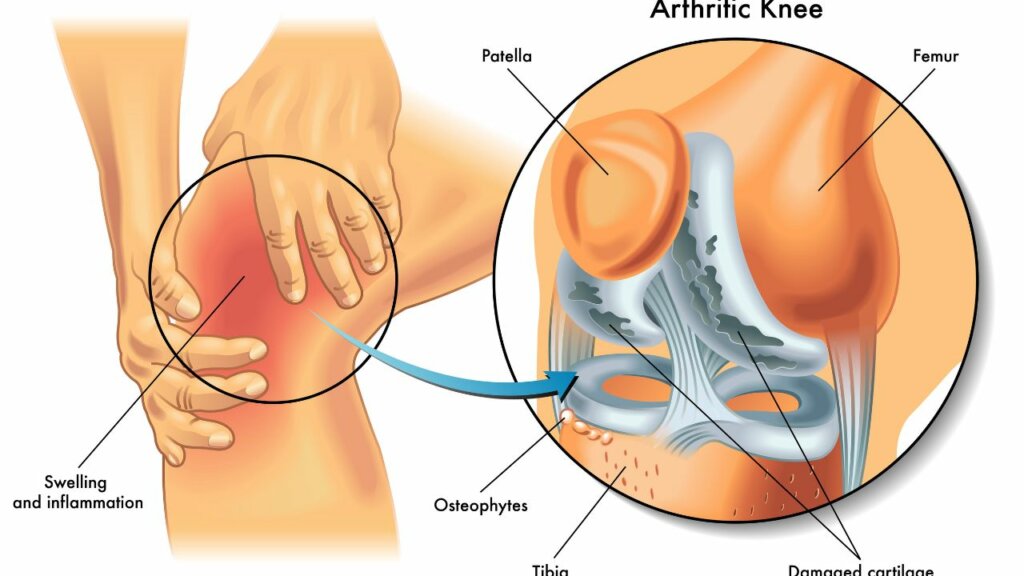 arthritic knee